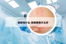 肤藓怕什么 皮肤癣用什么好