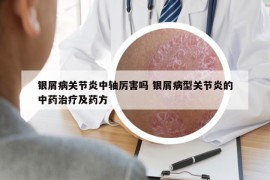 银屑病关节炎中轴厉害吗 银屑病型关节炎的中药治疗及药方