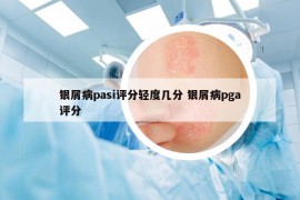 银屑病pasi评分轻度几分 银屑病pga评分