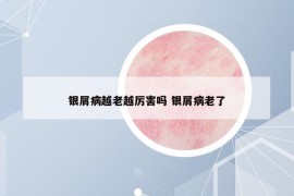 银屑病越老越厉害吗 银屑病老了