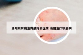 洛阳银屑病治得最好的医生 洛阳治疗银屑病