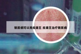 银屑病可以用皮康王 皮康王治疗银屑病