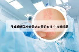 牛皮癣爆发全身最大力量的方法 牛皮癣经历