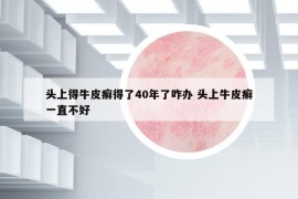 头上得牛皮癣得了40年了咋办 头上牛皮癣一直不好