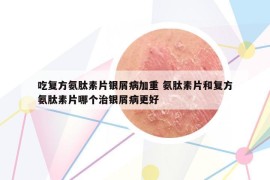 吃复方氨肽素片银屑病加重 氨肽素片和复方氨肽素片哪个治银屑病更好