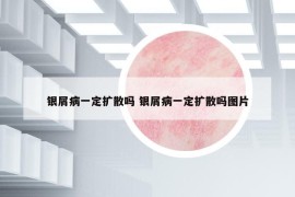 银屑病一定扩散吗 银屑病一定扩散吗图片