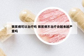 银屑病可以治疗吗 银屑病不治疗会越来越严重吗