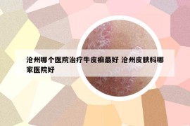 沧州哪个医院治疗牛皮癣最好 沧州皮肤科哪家医院好