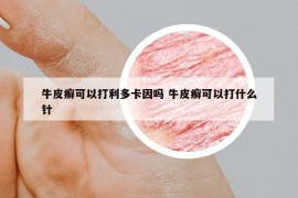 牛皮癣可以打利多卡因吗 牛皮癣可以打什么针