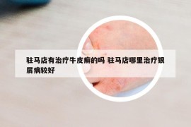 驻马店有治疗牛皮癣的吗 驻马店哪里治疗银屑病较好