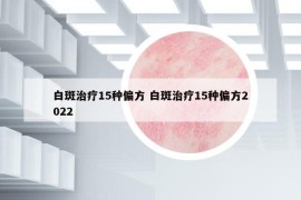 白斑治疗15种偏方 白斑治疗15种偏方2022