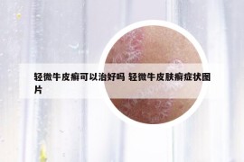 轻微牛皮癣可以治好吗 轻微牛皮肤癣症状图片