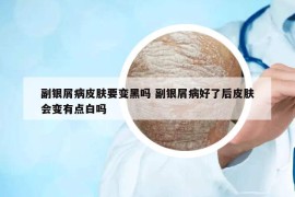 副银屑病皮肤要变黑吗 副银屑病好了后皮肤会变有点白吗