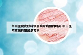 华山医院皮肤科银屑病专病预约时间 华山医院皮肤科银屑病专家