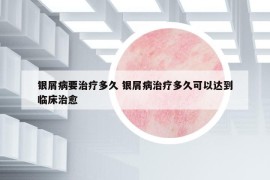 银屑病要治疗多久 银屑病治疗多久可以达到临床治愈
