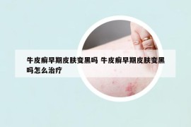 牛皮癣早期皮肤变黑吗 牛皮癣早期皮肤变黑吗怎么治疗