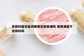 皮肤科医生能肉眼看出银屑病吗 银屑病属于皮肤科吗