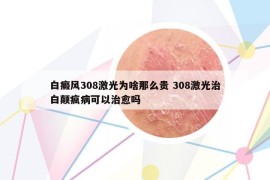 白癜风308激光为啥那么贵 308激光治白颠疯病可以治愈吗