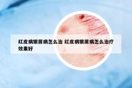 红皮病银屑病怎么治 红皮病银屑病怎么治疗效果好