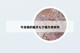 牛皮癣的偏方七个偏方很有效