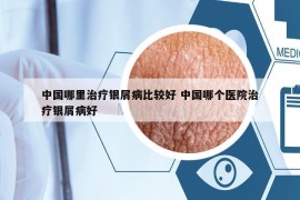 中国哪里治疗银屑病比较好 中国哪个医院治疗银屑病好