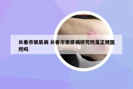 长春市银屑病 长春市银屑病研究院是正规医院吗