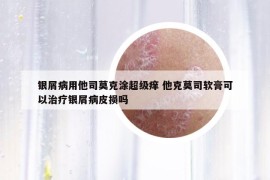 银屑病用他司莫克涂超级痒 他克莫司软膏可以治疗银屑病皮损吗