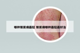 哪种银屑病最轻 银屑病哪种最轻最好治