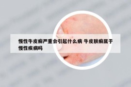 慢性牛皮癣严重会引起什么病 牛皮肤癣属于慢性疾病吗