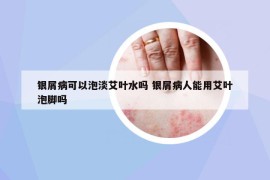 银屑病可以泡淡艾叶水吗 银屑病人能用艾叶泡脚吗