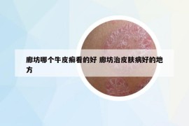 廊坊哪个牛皮癣看的好 廊坊治皮肤病好的地方