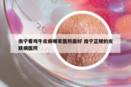 南宁看鸡牛皮癣哪家医院最好 南宁正规的皮肤病医院