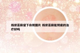 线状苔藓留下白斑图片 线状苔藓能彻底的治疗好吗