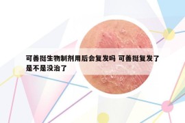 可善挺生物制剂用后会复发吗 可善挺复发了是不是没治了