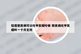 轻度银屑病可以吃甲氨蝶呤嘛 银屑病吃甲氨蝶呤一个月无效