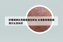 好看视频头发银屑病怎样治 头发里有银屑病用什么洗头好