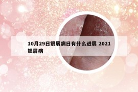 10月29日银屑病日有什么进展 2021银屑病