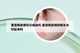 重度银屑病可以病退吗 重度银屑病到晚年会好起来吗