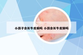 小孩子会长牛皮癣吗 小孩会长牛皮鲜吗