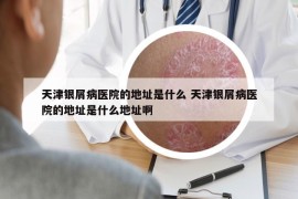 天津银屑病医院的地址是什么 天津银屑病医院的地址是什么地址啊