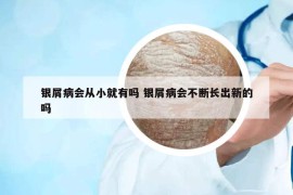 银屑病会从小就有吗 银屑病会不断长出新的吗