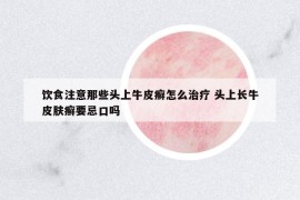 饮食注意那些头上牛皮癣怎么治疗 头上长牛皮肤癣要忌口吗
