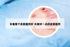 长春那个皮肤医院好 长春好一点的皮肤医院