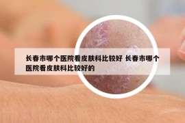 长春市哪个医院看皮肤科比较好 长春市哪个医院看皮肤科比较好的