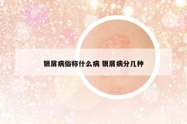 银屑病俗称什么病 银屑病分几种