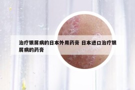 治疗银屑病的日本外用药膏 日本进口治疗银屑病的药膏