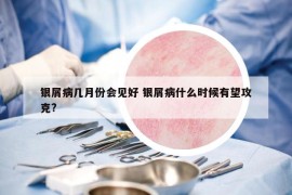 银屑病几月份会见好 银屑病什么时候有望攻克?