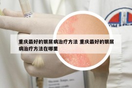 重庆最好的银屑病治疗方法 重庆最好的银屑病治疗方法在哪里