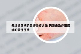 天津银屑病的最好治疗方法 天津市治疗银屑病的最佳医院