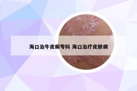海口治牛皮癣专科 海口治疗皮肤病